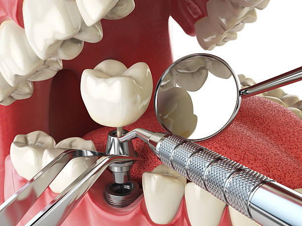 Best Emergency Dental Care for Broken or Chipped Teeth in Shokan, NY